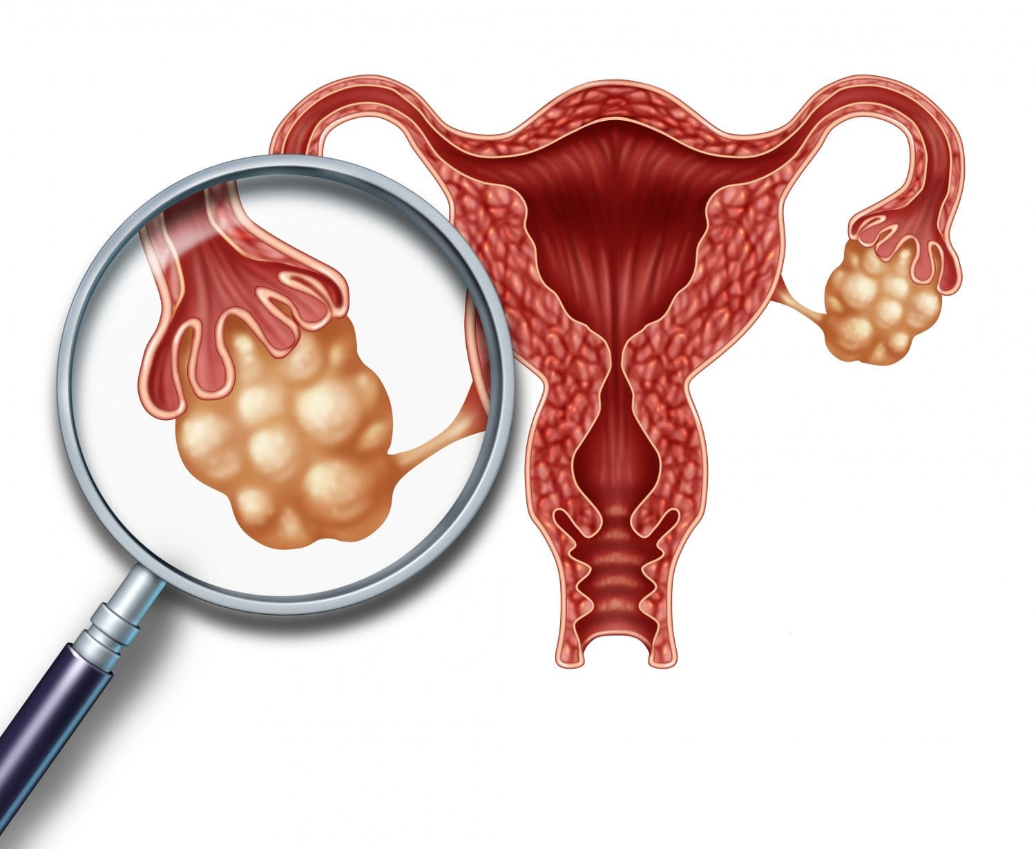 Natural Pcos Treatment Bne
