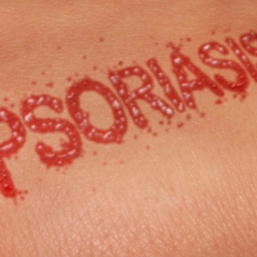 Psoriasis Brisbane