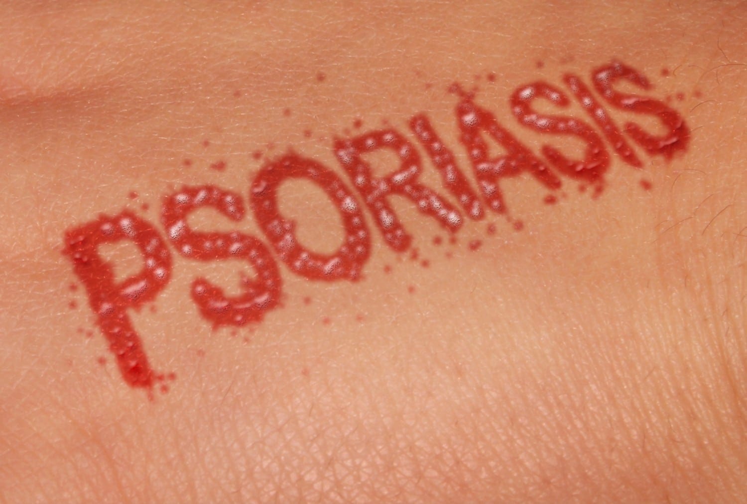 Psoriasis Brisbane