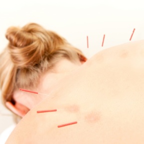 Acupuncture Patient Treatment In Back