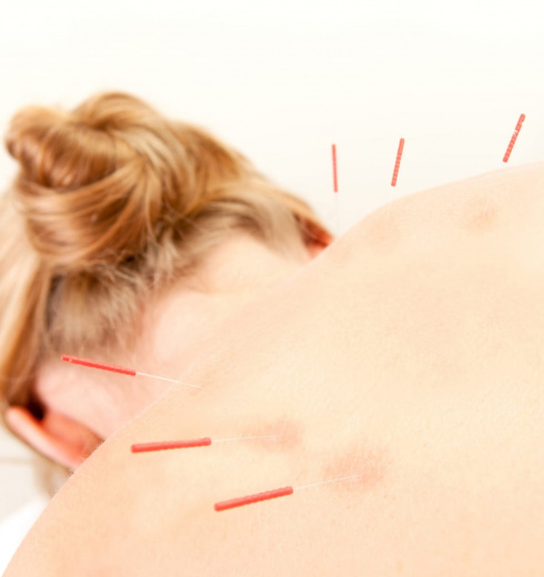 Acupuncture Patient Treatment In Back