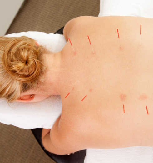 Acupuncture Brisbane