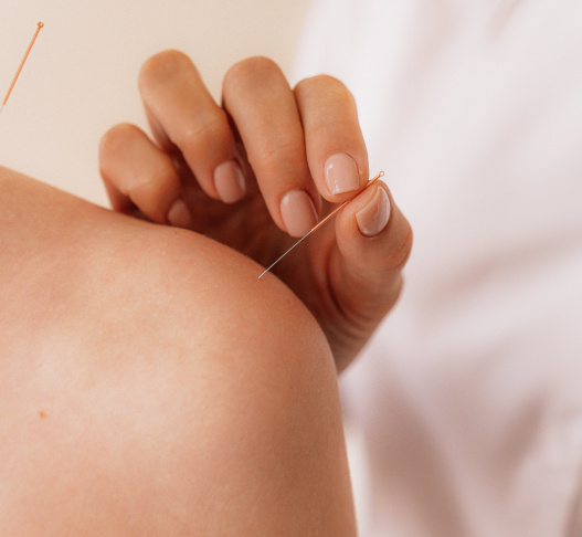 Can Acupuncture Help Anxiety